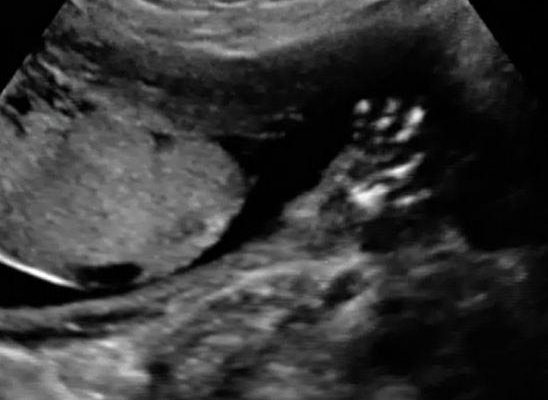 Fetal_Ultrasound_hand